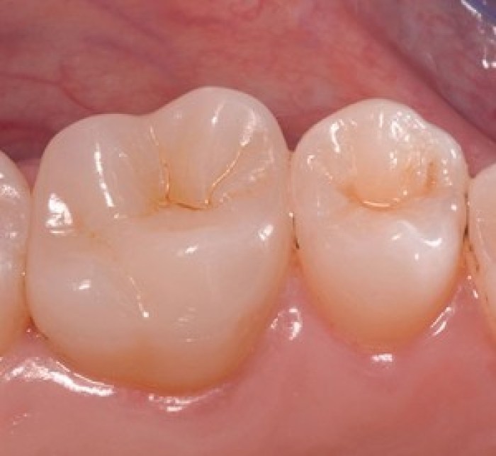 Best cement for zirconia crowns