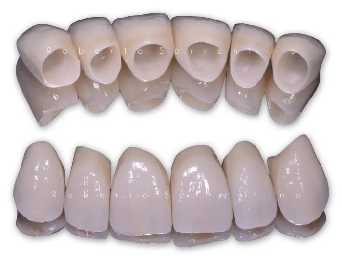 Best cement for zirconia crowns