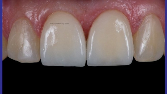 Zirconia crowns zirconiu coroana lucrari zirconio bridges tooth integral zirconium porcelain restorations protetice implants dentara implant winston salem dentistry layered